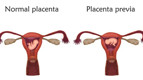 Voorliggende placenta of placenta previa