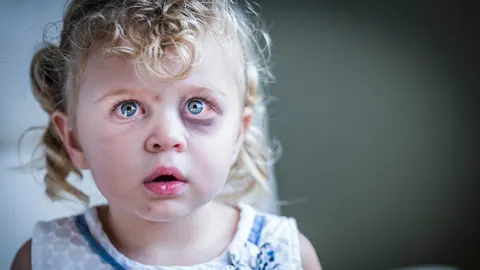 Wat doe je met een blauw oog?
