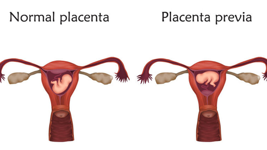 Voorliggende placenta of placenta previa