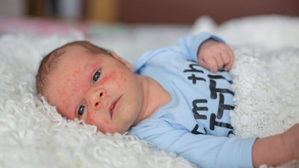 Baby acne, wat is het? Wat zijn toch die rode pukkeltjes?