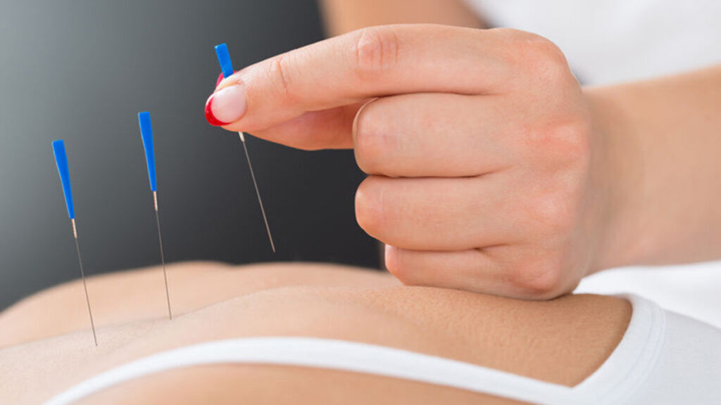 Acupunctuur en zwangerschap. Kan het kwaad?
